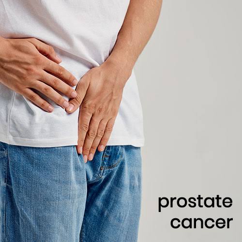 Prostrate cancer